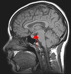 https://upload.wikimedia.org/wikipedia/commons/b/b6/Hypothalamus.jpg